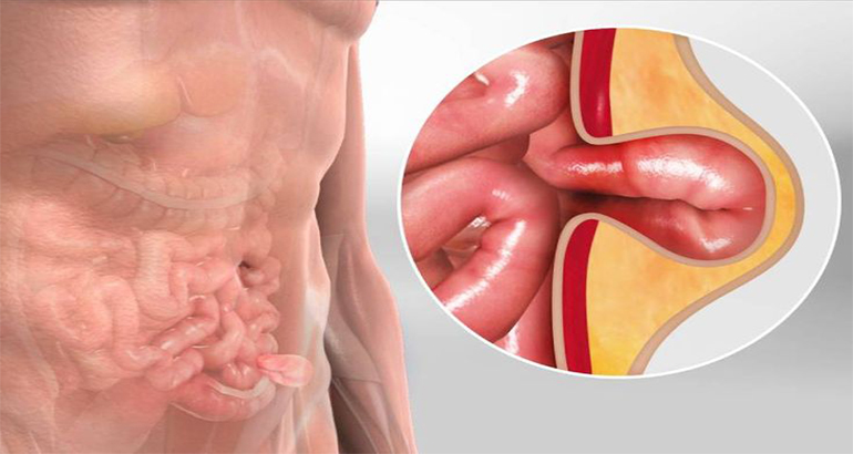 Hernia