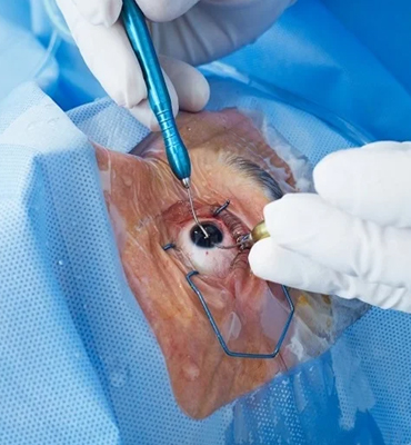 Cataract surgery