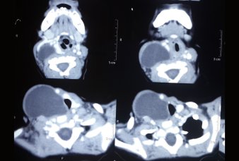 Best Pediatric Urologist in Ahmedabad, Child Urologist in Ahmedabad, Hirschsprung’s disease in Rajasthan, Hirschsprung Disease Treatment