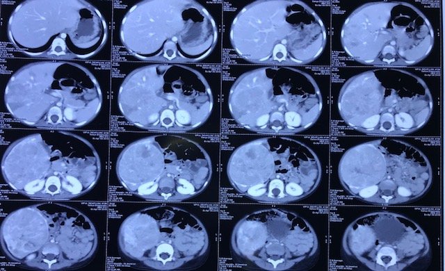 CT Scan of Abdomen showing Large Liver Tumor arising rom right lobe of Liver CT Scan of Abdomen showing Large Liver Tumor arising rom right lobe of Liver