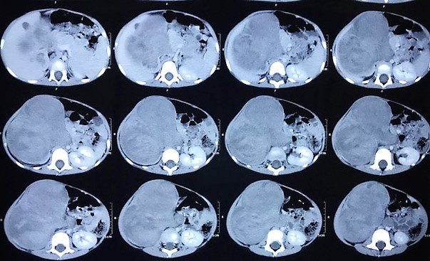 CT Scan showing Large Tumor Arising from Right Kidney CT Scan showing Large Tumor Arising from Right Kidney
