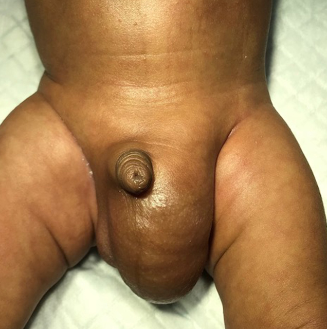 Left Inguinal Hernia Left Inguinal Hernia